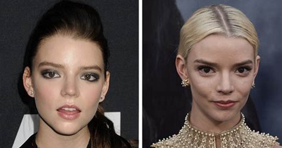 Anya Taylor-Joy’s Plastic Surgery: Did the Menu Cast Have Blepharoplasty, Brow Lift, and Buccal Fat Removal?