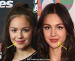 Did Olivia Rodrigo Get Breast Implants? Before and After Plastic Surgery Photos Compared