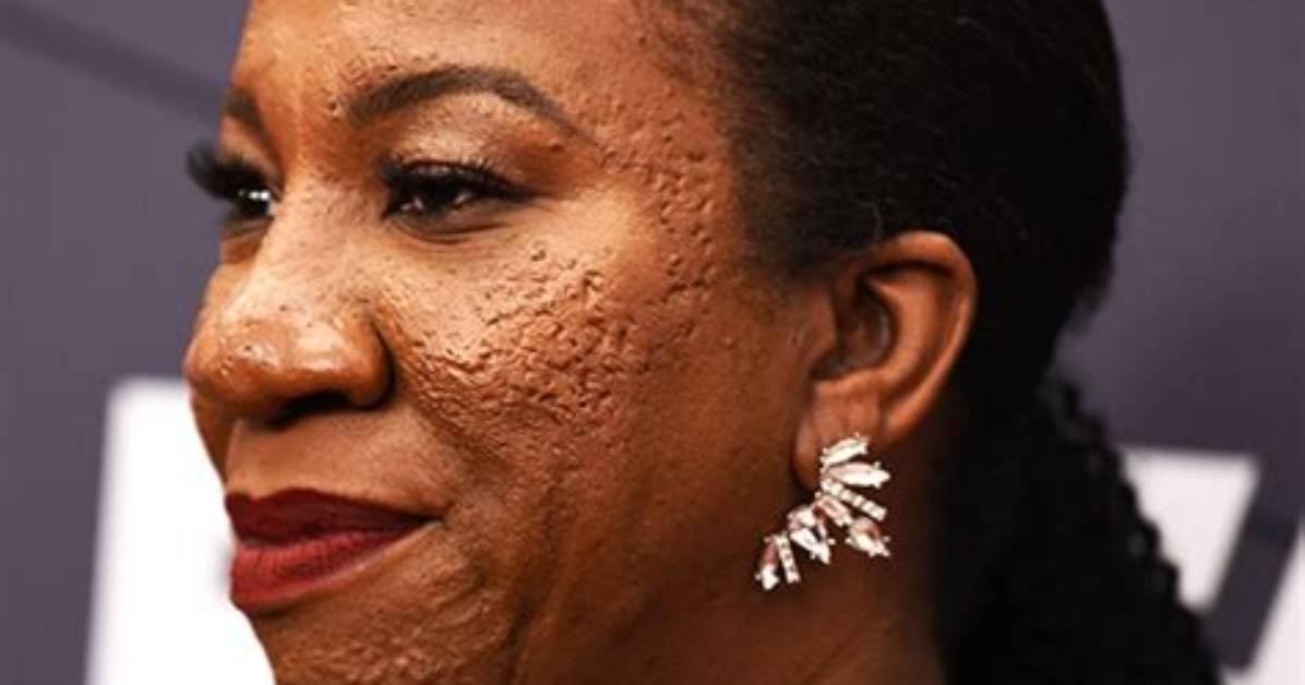 Does Tarana Burke Have a Skin Condition? What Happened to Her Face?