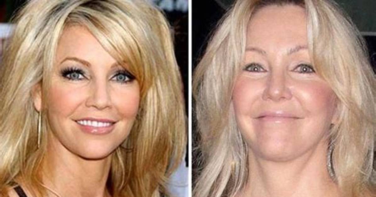 Heather Locklear Face Lift and Plastic Surgery – Weight Gain Explained