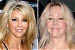 Heather Locklear Face Lift and Plastic Surgery – Weight Gain Explained