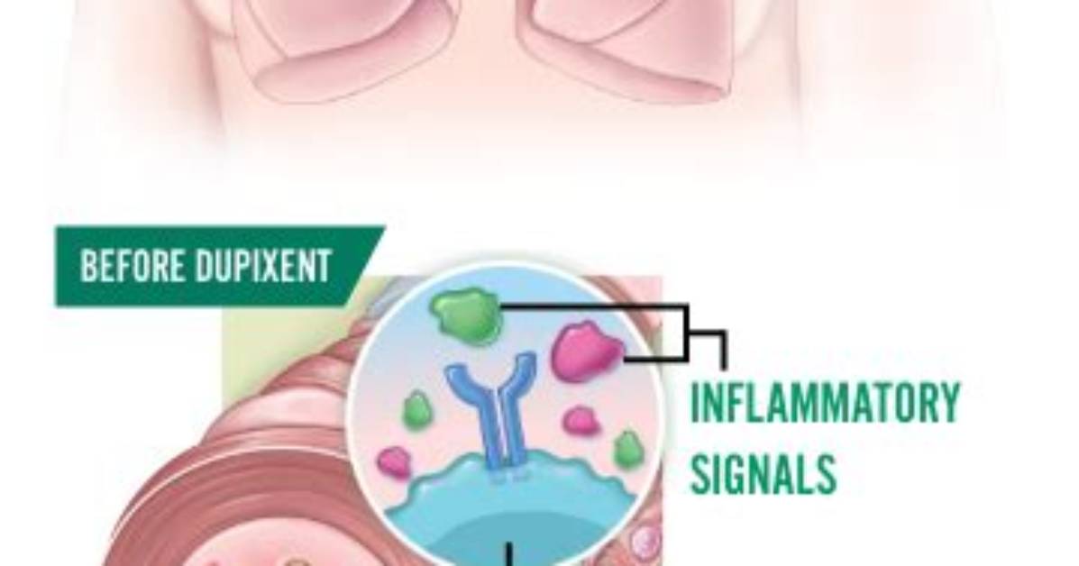 How Does Dupixent Work