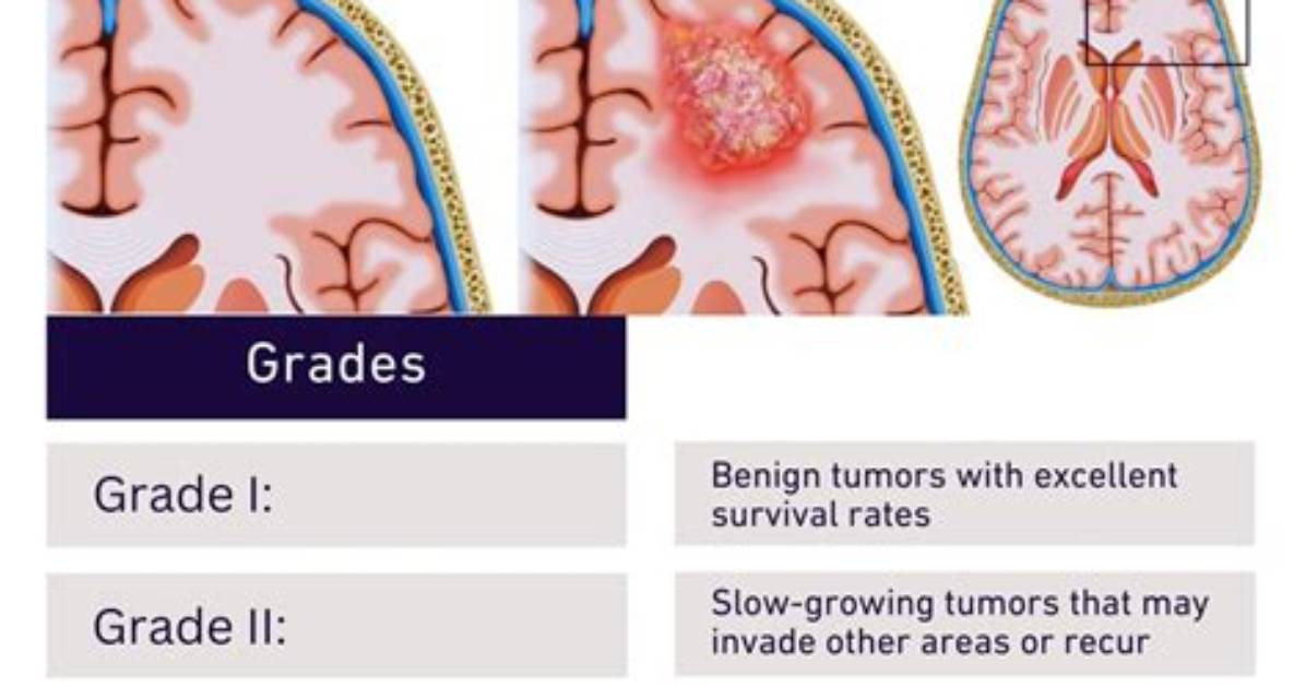 How Fast Do Brain Tumors Grow
