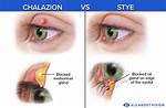How Long Does a Chalazion Take to Drain