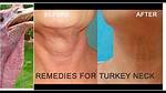 How to Get Rid of Chicken Neck