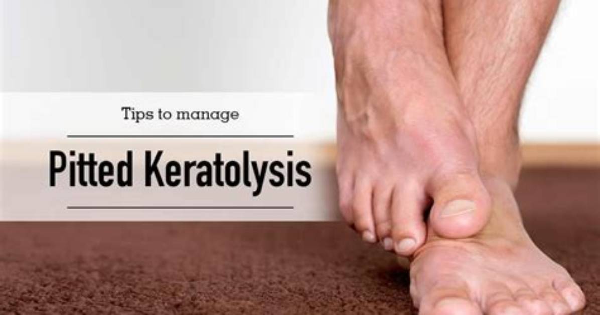 How to Get Rid of Pitted Keratolysis