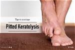 How to Get Rid of Pitted Keratolysis