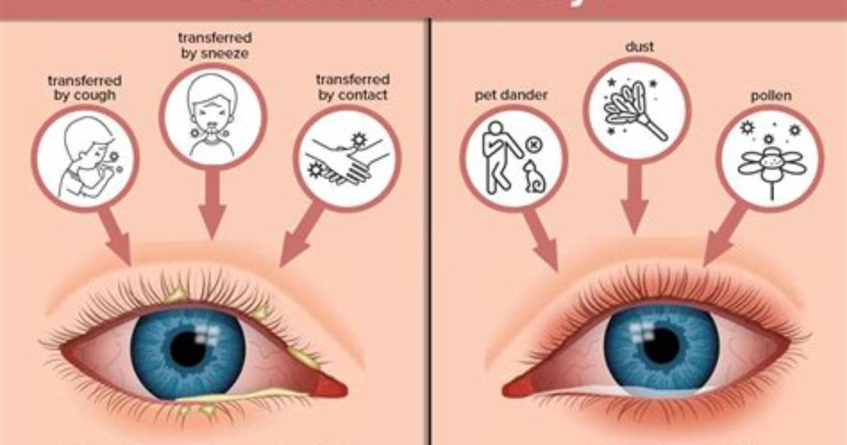 How to Know If Pink Eye Is Healing