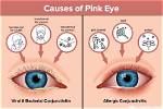 How to Know If Pink Eye Is Healing