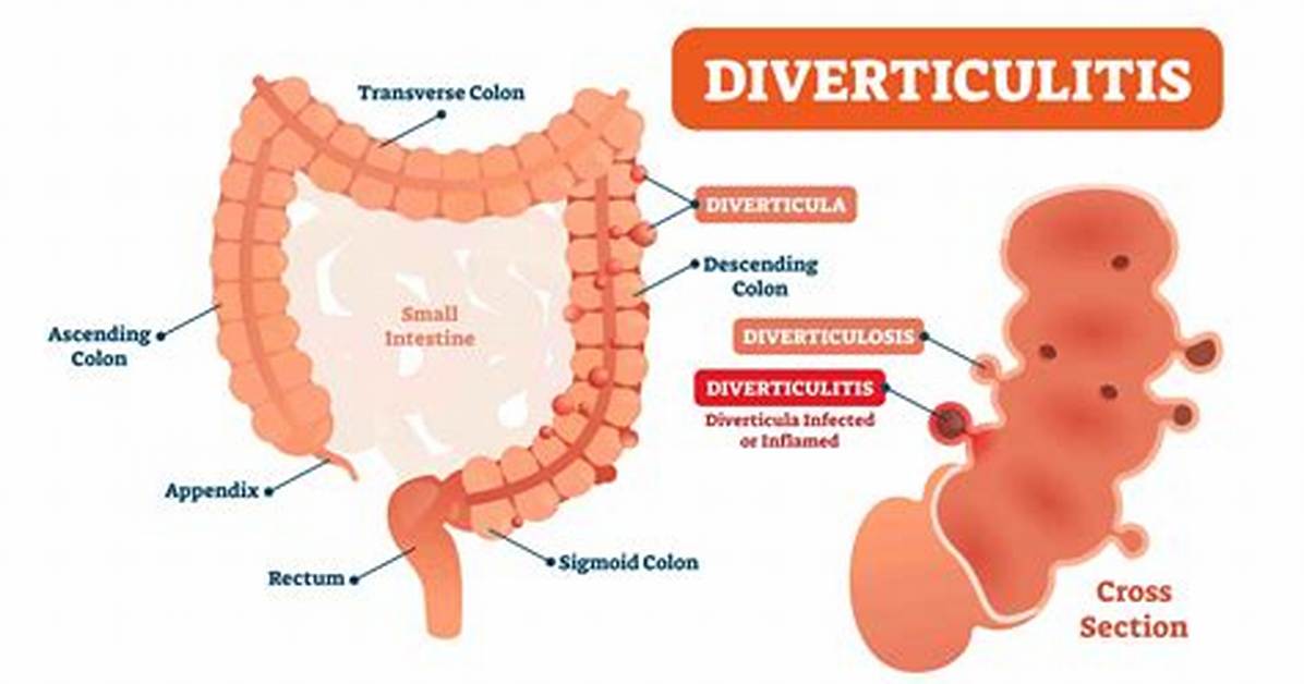 How to Pronounce Diverticulitis