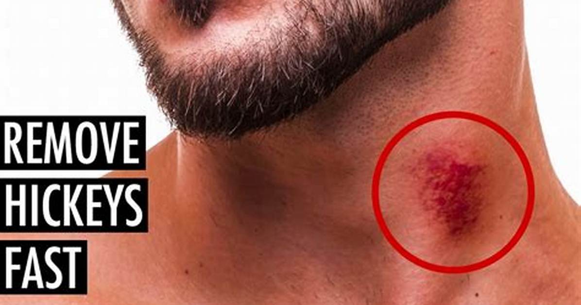 How to Remove a Hickey Fast