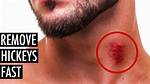 How to Remove a Hickey Fast