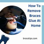 How to Remove Braces Glue