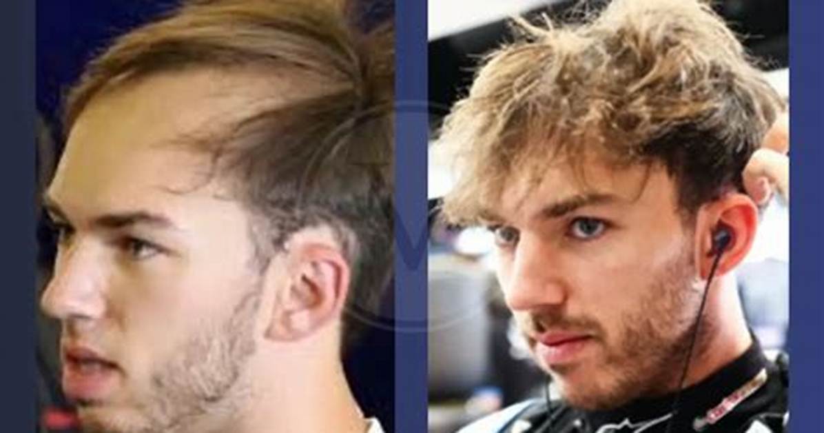 Is Pierre Gasly Bald Now? What Happened to His Hair? Health Update