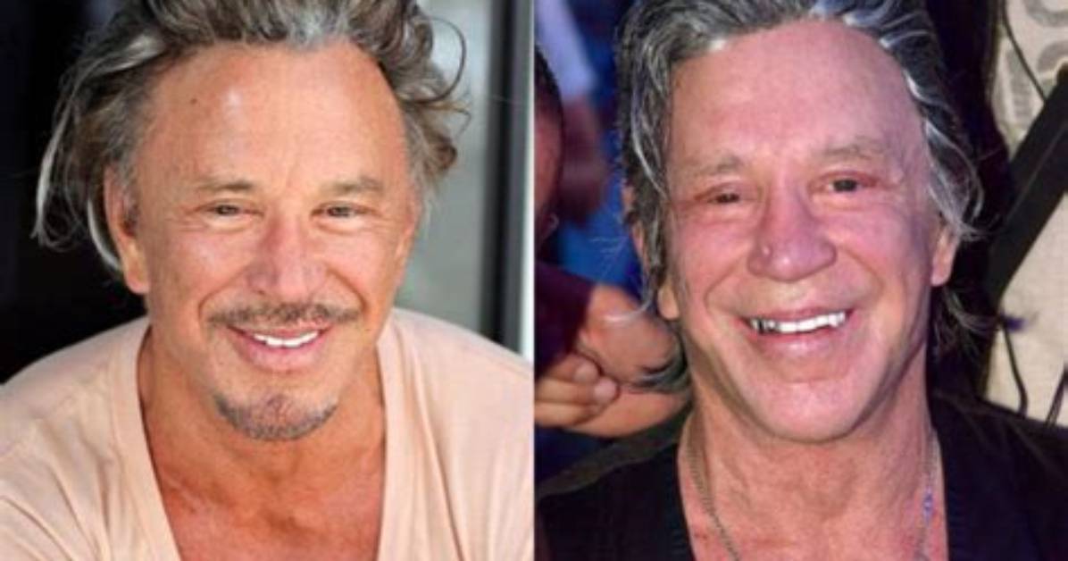 Photos: Mickey Rourke Plastic Surgery; Before & After Transformation Update