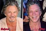 Photos: Mickey Rourke Plastic Surgery; Before & After Transformation Update