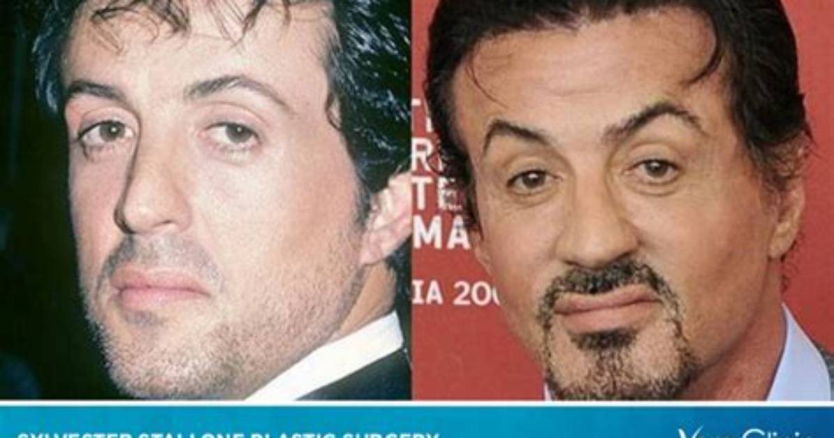 Sylvester Stallone Heart Surgery: Did He Get a Stroke? Health Update