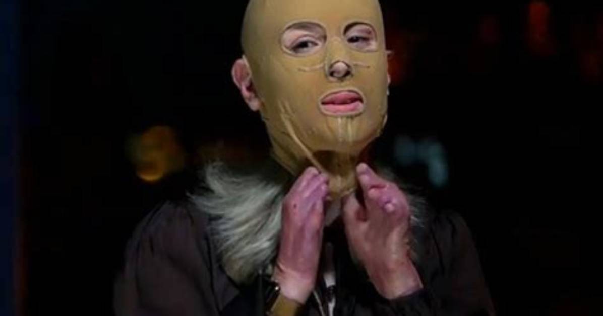 What Happened to Stephanie Browitt Face? 60 Minutes Unmask the Story of White Island Volcano Survivor