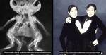 What Happens If One Conjoined Twin Dies