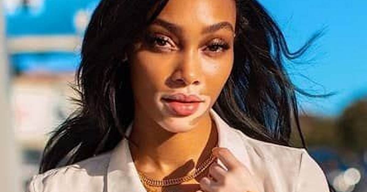 Winnie Harlow (Model) Wiki, Bio, Age, Height, Weight, Boyfriend, Measurements, Net Worth, Family, Facts