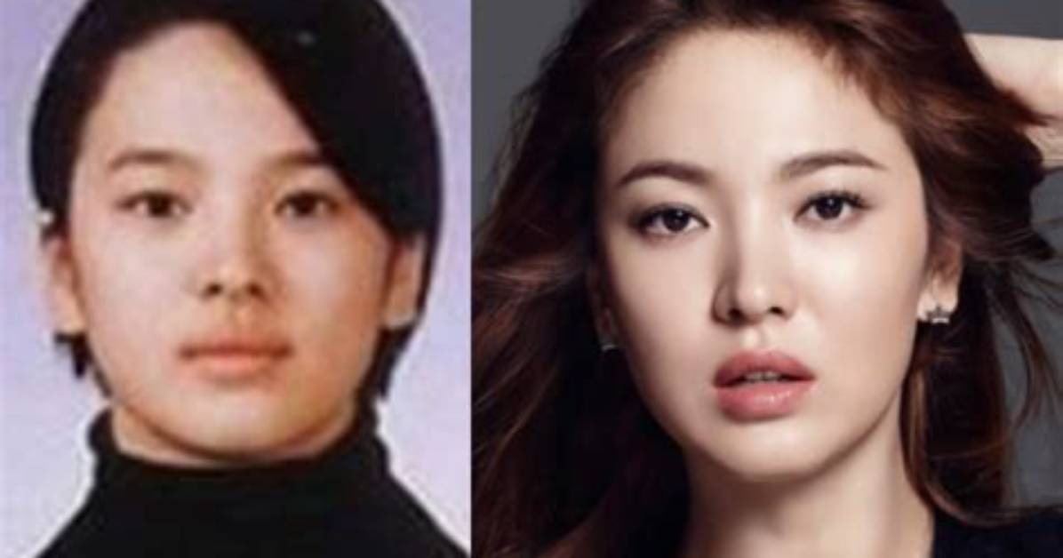 Youtuber: Song Jia Before & Plastic Surgery – Her Transformation Exposed